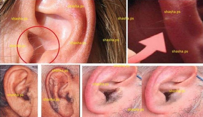 ارتباط میان موهای روی گوش با سکته قلبی
