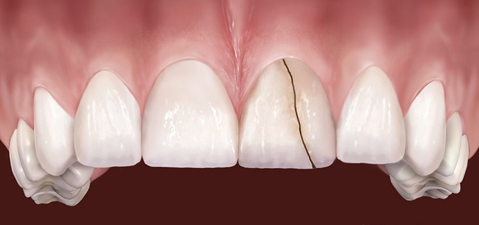  آیا خرابی دندان‌ها ارثی است؟