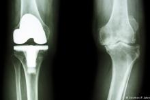 روش کاهش دردهای آرتروزی