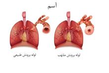 آسم چیست و چگونه ایجاد می شود؟