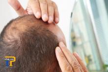 دانشمندان راهی برای درمان طاسی یافتند