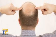 افراد طاس به نوع شدید کرونا مبتلا می‌شوند؟