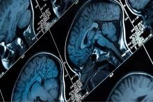 رمزگشایی سیگنال&zwnj;های مغزی برای احساس درد توسط محققان برای اولین بار