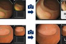 بهره&zwnj;گیری از هوش مصنوعی برای تشخیص سرطان روده در مراحل آغازین