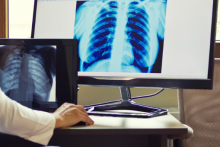 تشخیص سریع سرطان ریه با کمک هوش مصنوعی