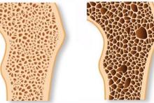 راه‌های پیشگیری از پوکی استخوان را بشناسید