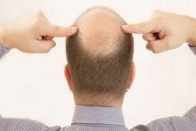 دانشمندان علت طاسی سر را کشف کردند