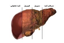 پنج عاملی که خطر ابتلا به بیماری کبدی را افزایش می‌دهد