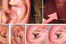 ارتباط میان موهای روی گوش با سکته قلبی