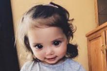 سندرمی نادر دختر خردسال را صاحب چشمانی فوق العاده زیبا کرد