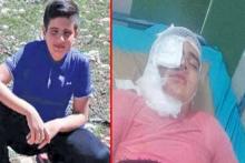 عکس قبل و بعد اسیدپاشی به پسر دانش آموز 11 ساله کرمانشاهی