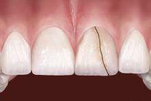  آیا خرابی دندان&zwnj;ها ارثی است؟