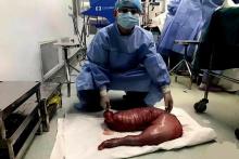 تصویری وحشتناک از روده یک بیمار مبتلا به هیرشپرونگه