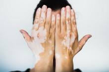 بیماری برص چیست؟