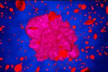 نتایج مثبت یک درمان جدید سرطان خون بر ۷۳ درصد از بیماران