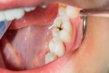 هفت نکته ساده برای جلوگیری از پوسیدگی دندان‌ها