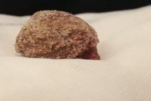 شاید باورتان نشود، این سنگ از کلیه یک بیمار خارج شده