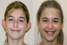 گوش بلبلی قابل درمان است؟