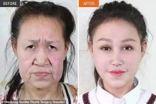 جراحی زیبایی یک پیرزن را به دختری 15 ساله تبدیل کرد (+عکس)