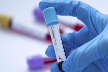 رونمایی از کیت ایرانی تشخیص بیماری کرونا 