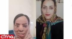 چهره عروس جوان تهرانی با اسید سوخت (+عکس قبل و بعد از حادثه)