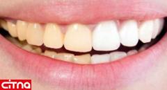دندان‌های سفید، شفاف و براق، استحکام و سلامت کمتری دارند