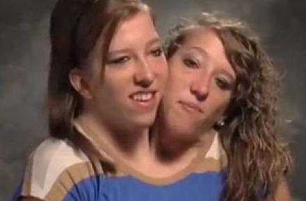 دختری با دو سر، تعجب کاربران اینترنت را برانگیخت! +عکس