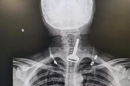 تا یک قدمی مرگ با بلعیدن سوئیچ خودرو