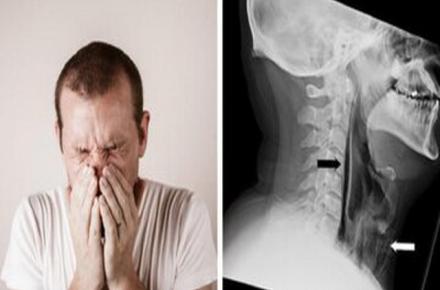 سوراخ شدن گلو بر اثر نگهداشتن عطسه