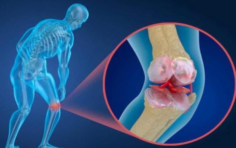 پوکی استخوان