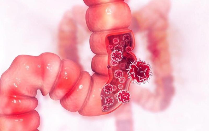 تشخیص سرطان