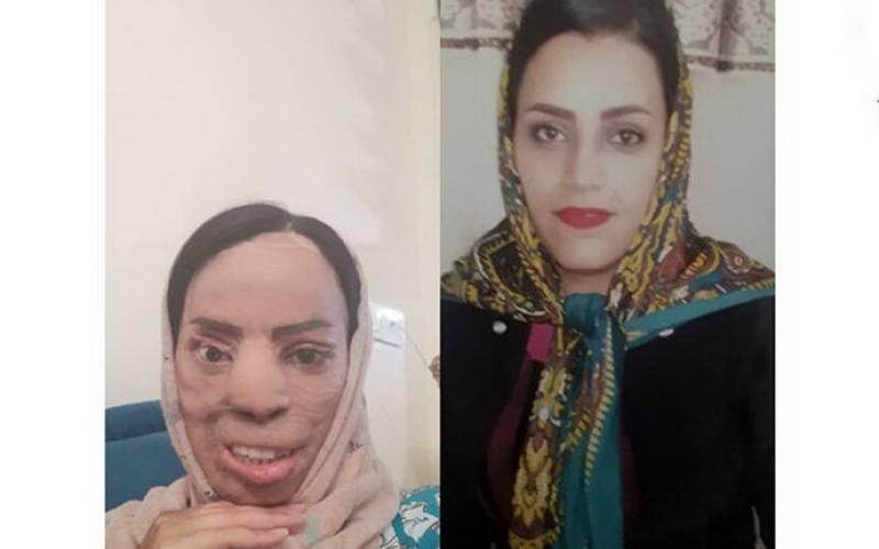 چهره عروس جوان تهرانی با اسید سوخت (+عکس قبل و بعد از حادثه)