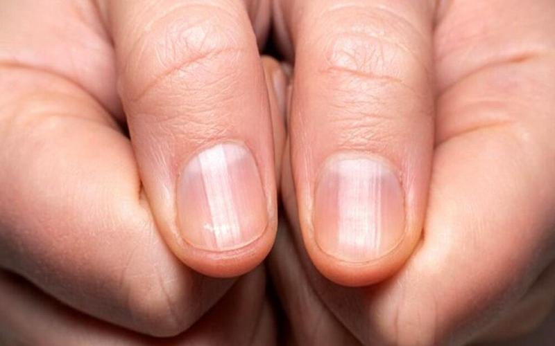 تغییر شکل ناخن نشانه کمبود کدام ماده ضروری در بدن است؟