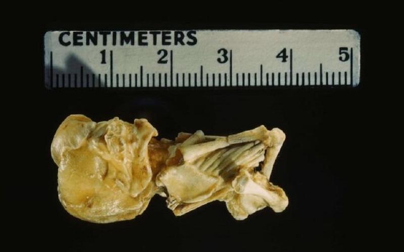 گزارش مورد نادر «جنین سنگی» در یک زن ۵۲ ساله ایرانی