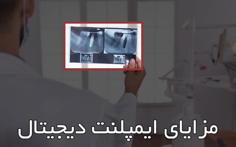 مزایا و معایب ایمپلنت دیجیتال (هشت فایده مهم)