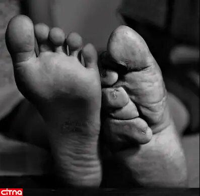عجیب ترین سنت دردناک چینی برای تبدیل پاها به کفش!